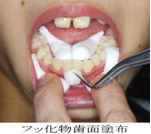 歯科医院における、むし歯予防のためのフッ素利用方法